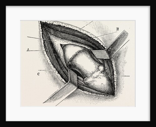 Excision of the hip by an external incision by Anonymous