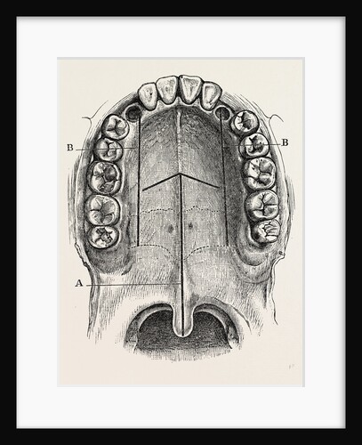 Nelaton's operation for nasal polypus by Anonymous