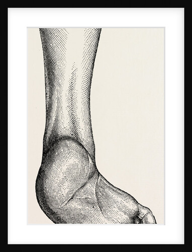 Incurved form of the foot, the planzar by Anonymous