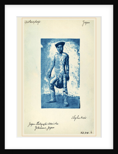 Elephantiasis, c. 1870s by Anonymous