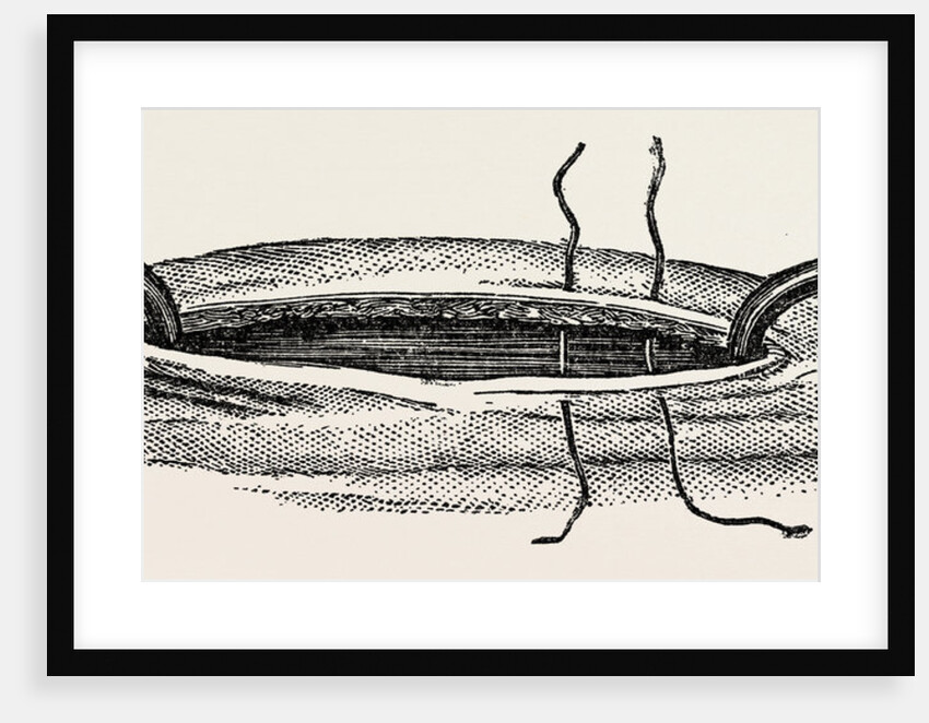Method of steadying the margins of a wound with blunt hooks by Anonymous