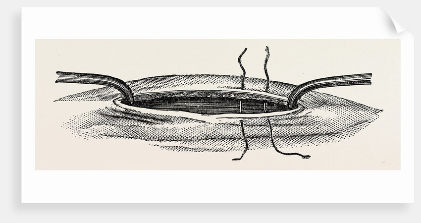 Method of steadying the margins of a wound with blunt hooks by Anonymous