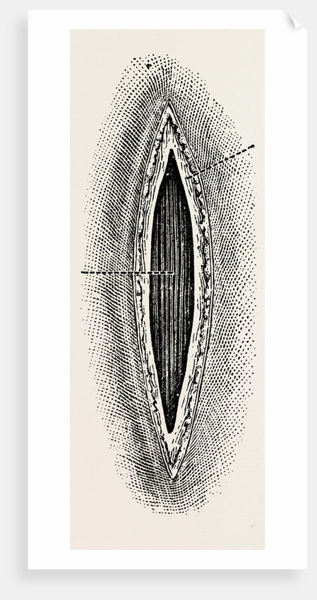Ligatuite of the right radial by Anonymous