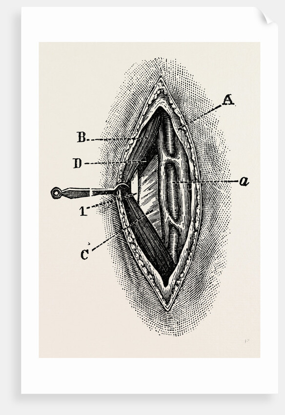 Ligatuite of the right radial by Anonymous