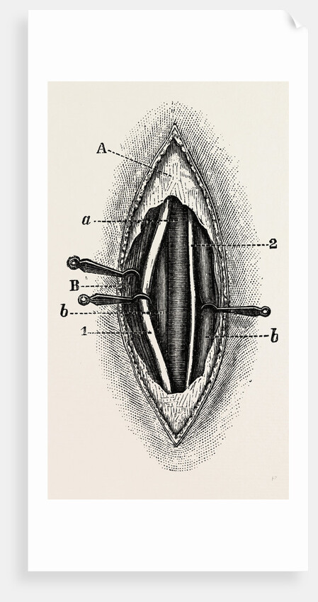 Ligature of the right finger by Anonymous