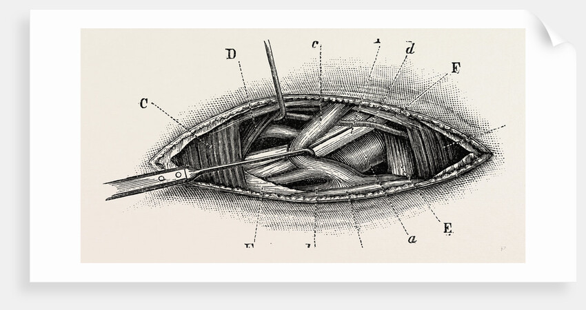 Ligature of the right subclavian ernird part by Anonymous