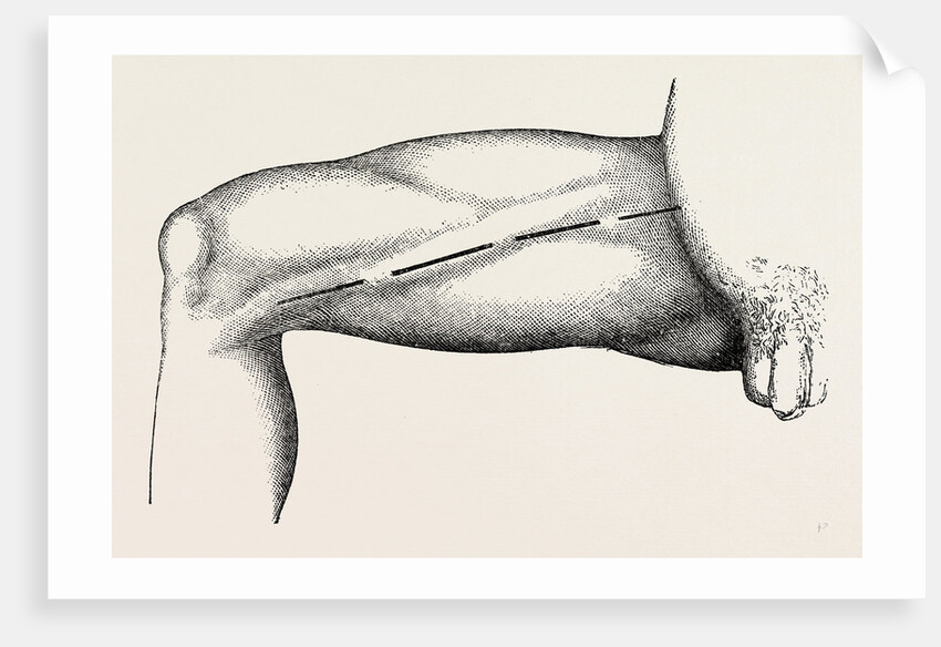 Ligature of the right common femoral at the base of scarpa's by Anonymous