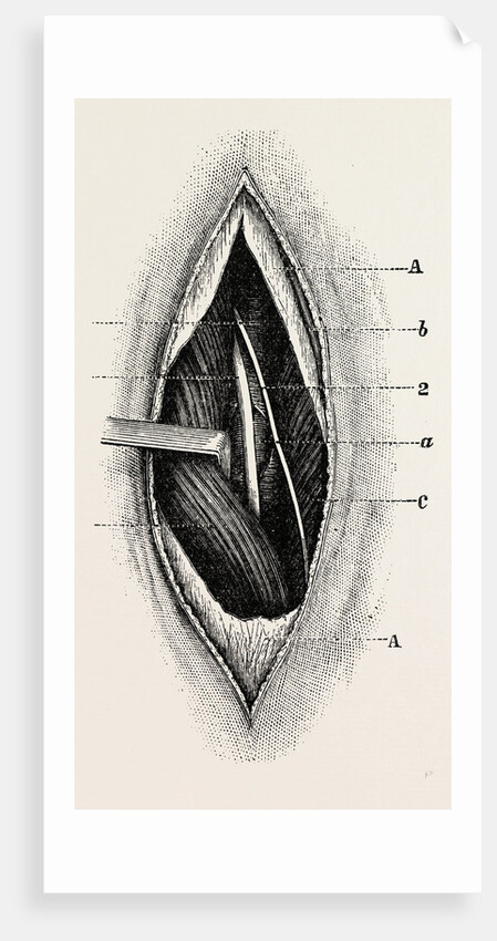 Ligature of by Anonymous