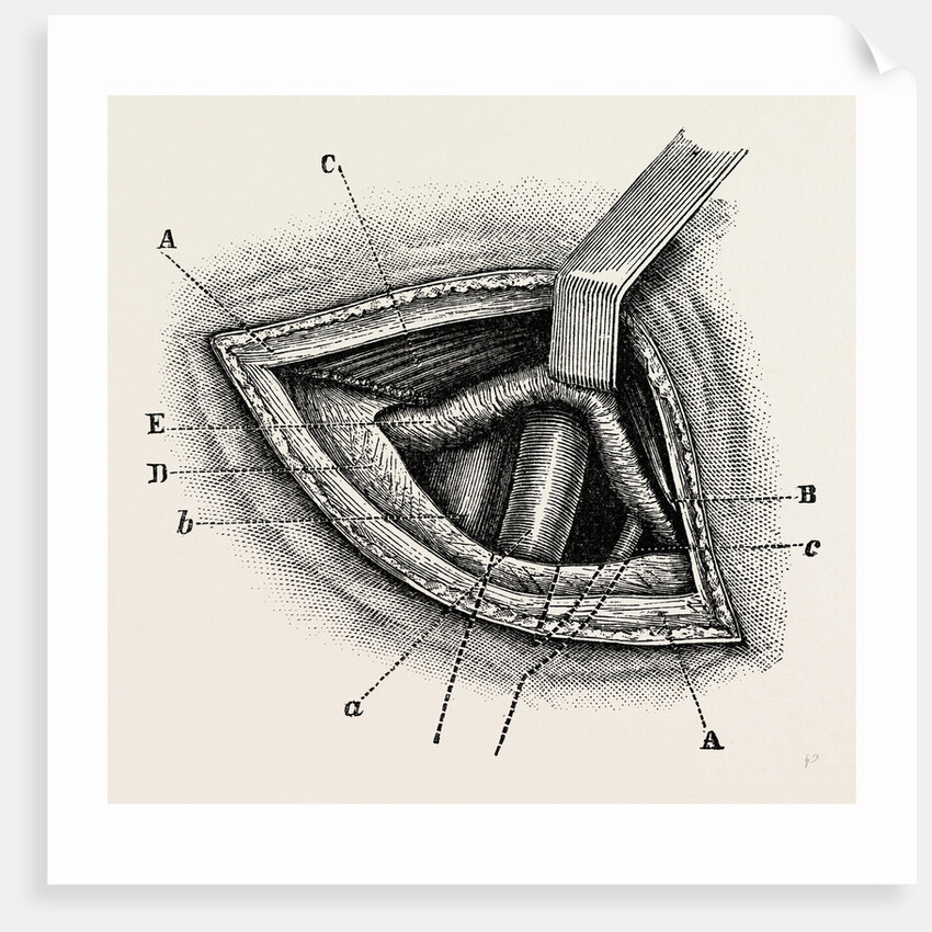 Ligature of right external iliac artery by Anonymous