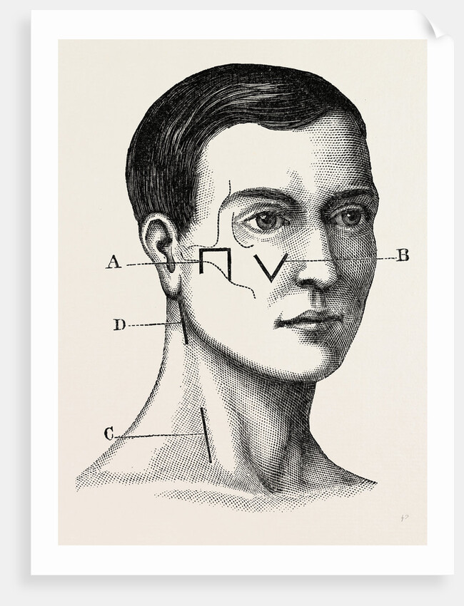 A neurotomy of third division by Anonymous