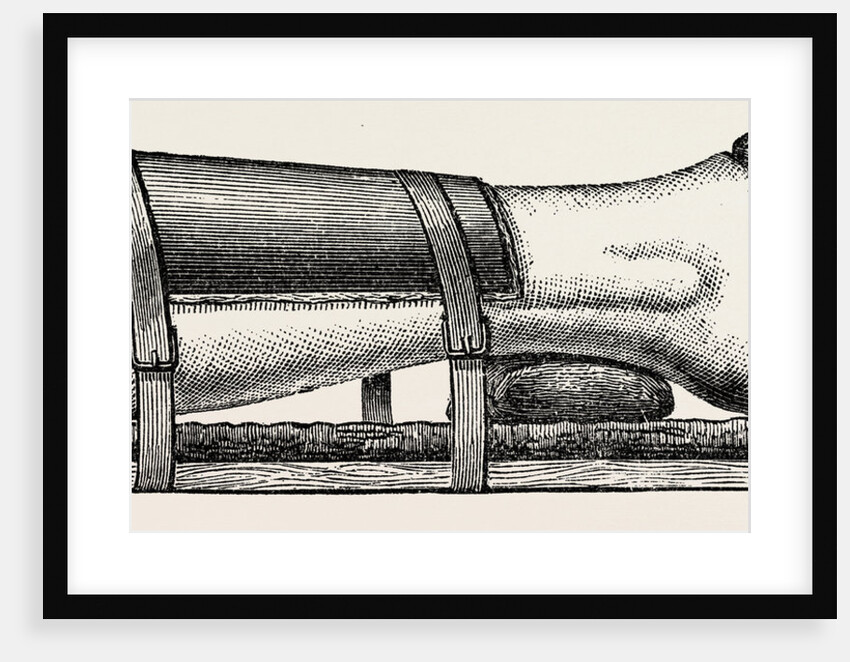 Supporting splint adjusted to the leg by Anonymous