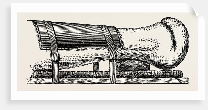 Supporting splint adjusted to the leg by Anonymous