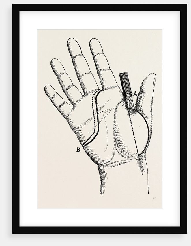 Disartieulation of the thumb by Anonymous