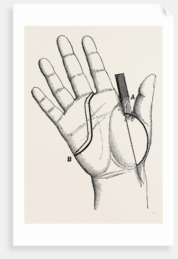 Disartieulation of the thumb by Anonymous