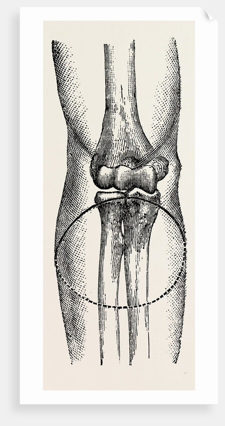 Disarticulation by Anonymous