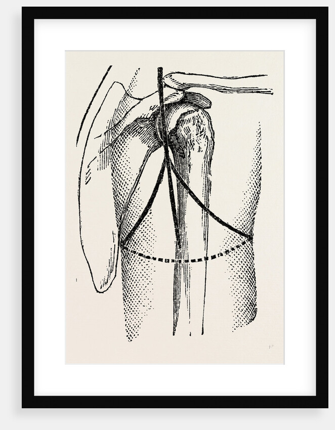 Disaetictjlation at the posterior part of the oval by Anonymous