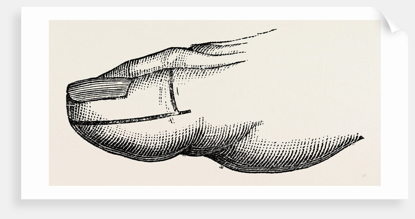 Disarticulation by Anonymous