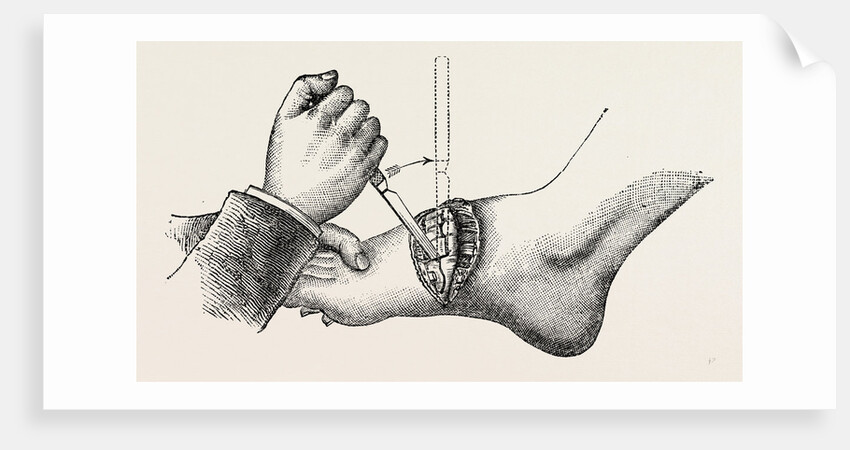 The coup de maitre in lisfrancis amputation by Anonymous