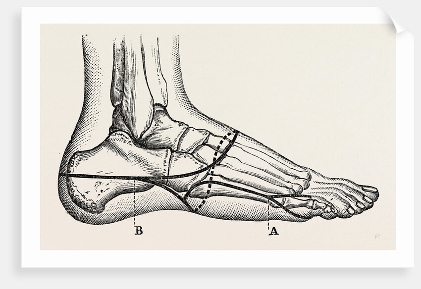 Disarticulation of the little toe by Anonymous