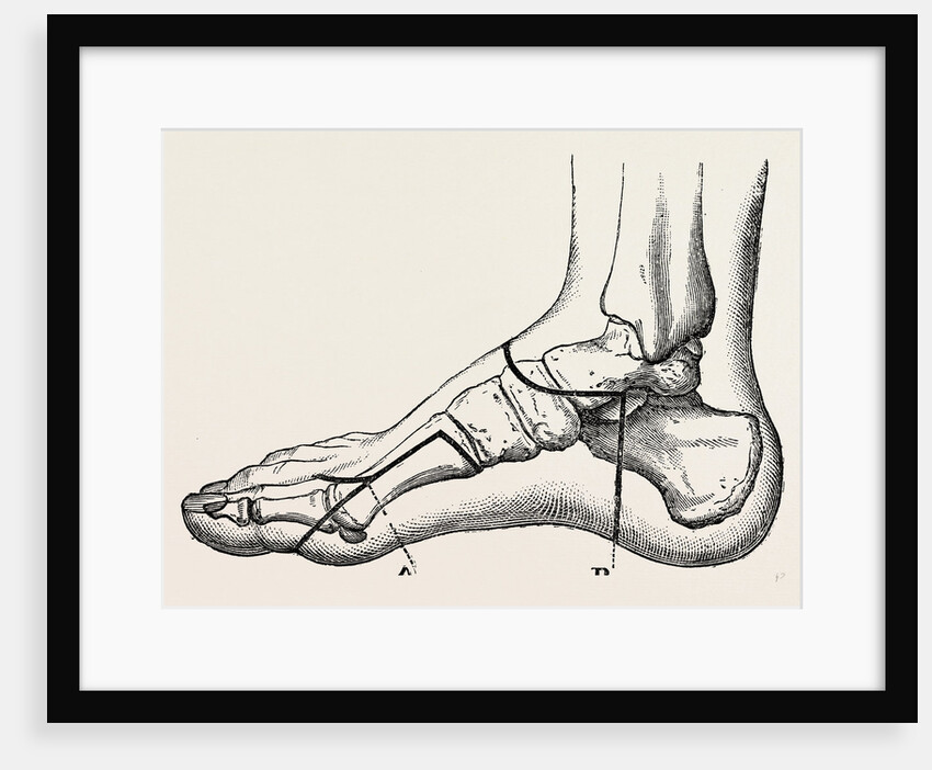 Disarticulation of the great toe by Anonymous