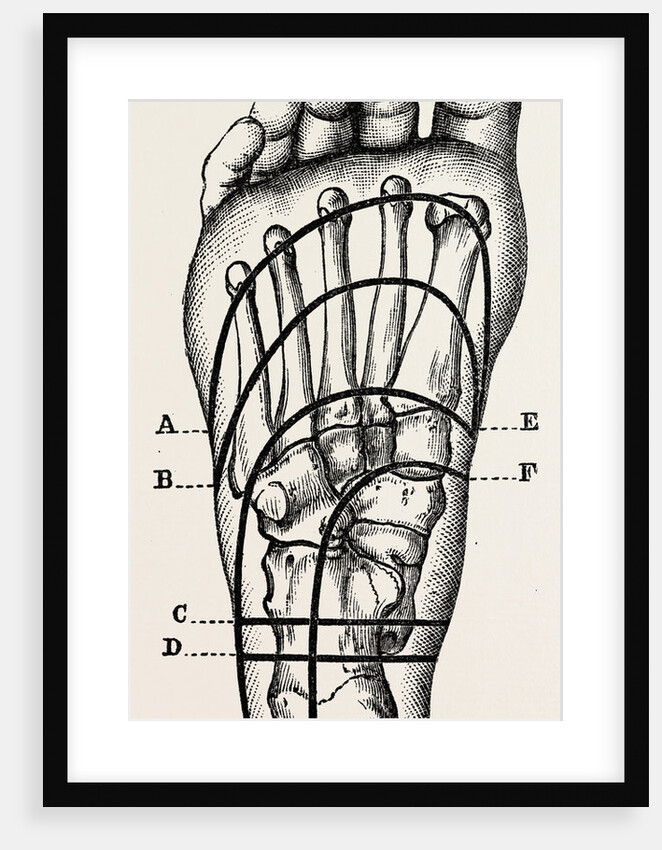 Plantar incisions by Anonymous
