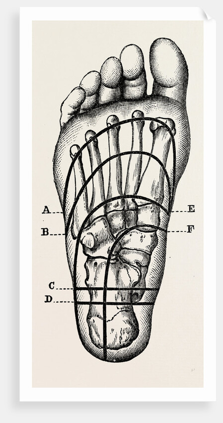 Plantar incisions by Anonymous