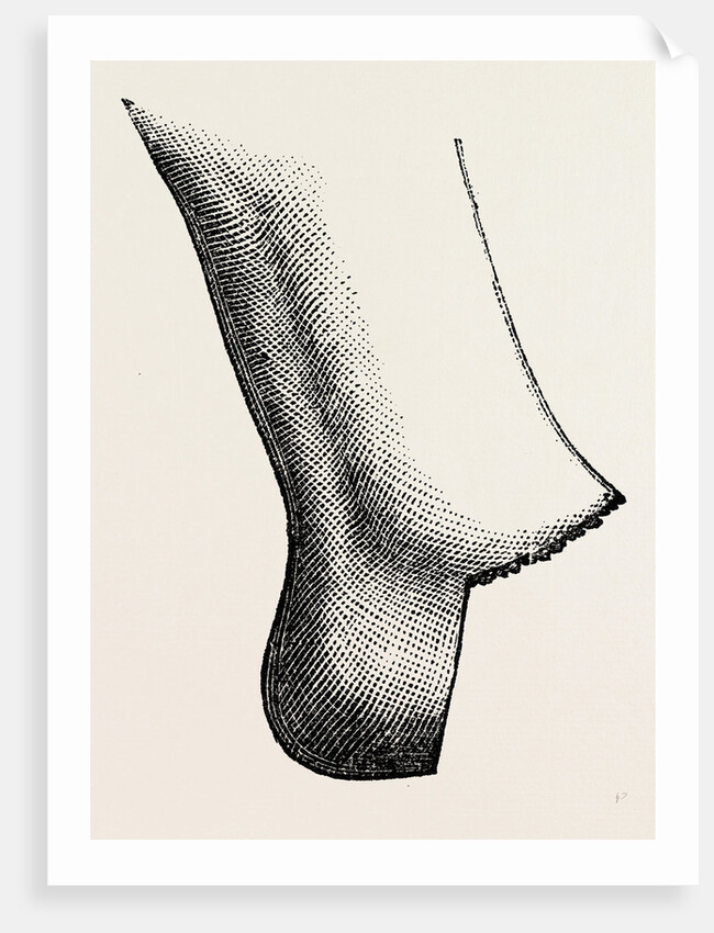 Syme's amputation by Anonymous