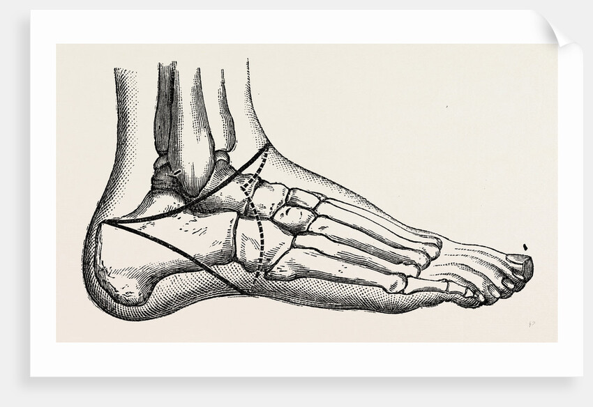 Roux's amputation by Anonymous