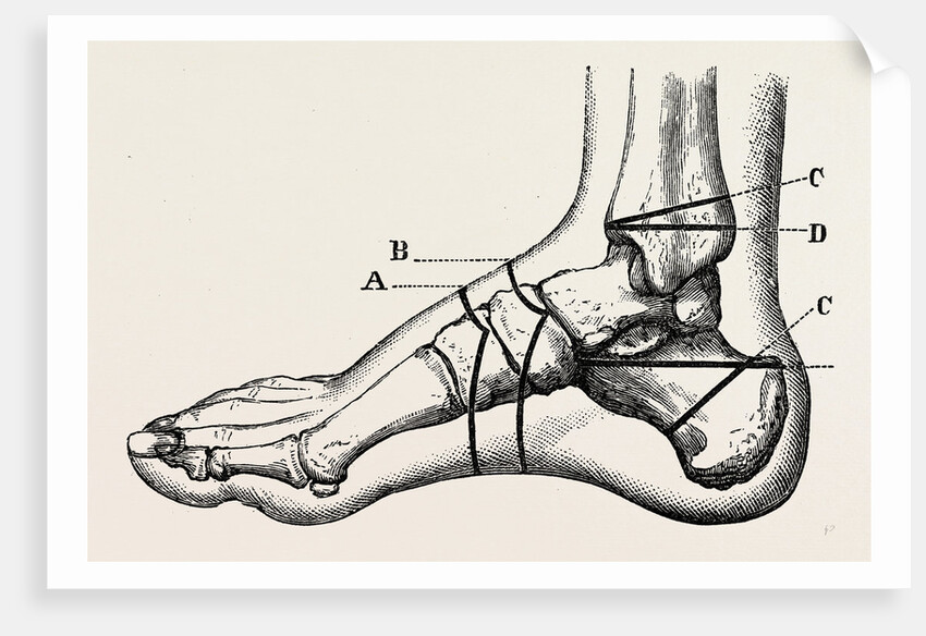 Farabeuf's subastragaloid amputation by Anonymous