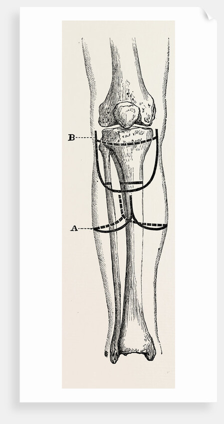 Amputation by Anonymous
