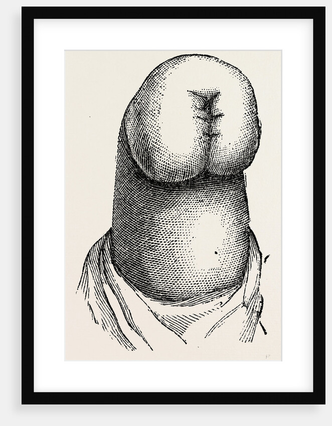 The stump by Anonymous