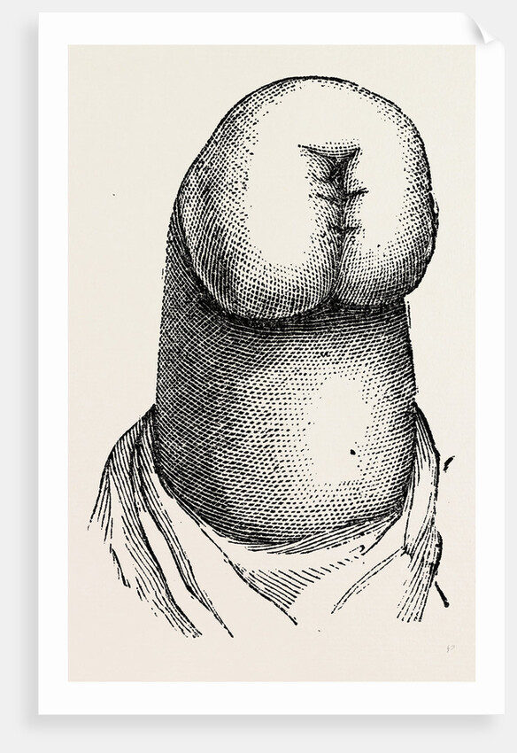 The stump by Anonymous