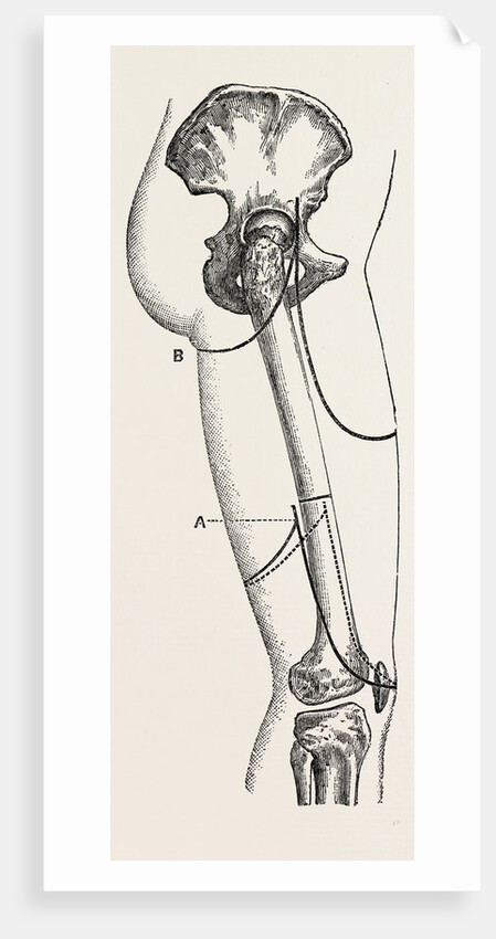 Amputation by Anonymous