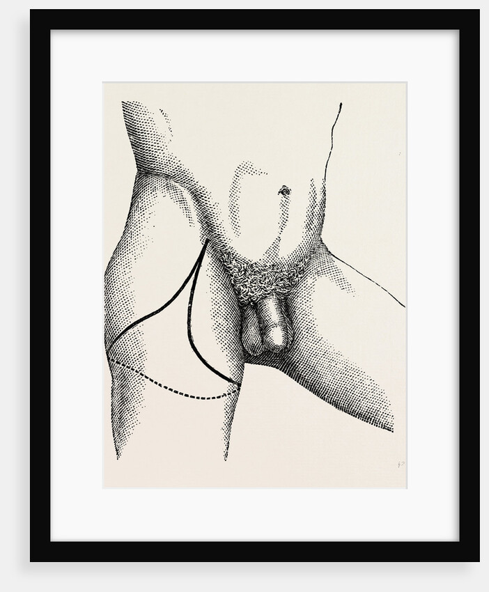 Disarticulation by Anonymous