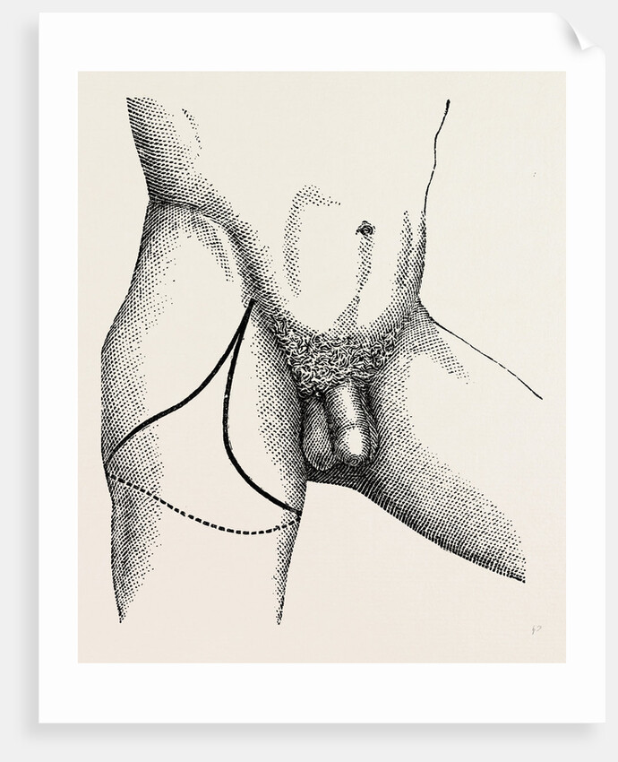 Disarticulation by Anonymous