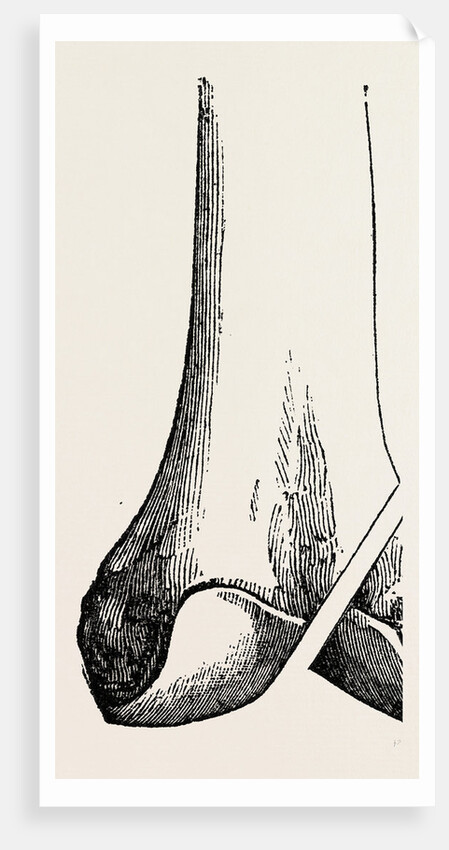 Ogston's operation by Anonymous