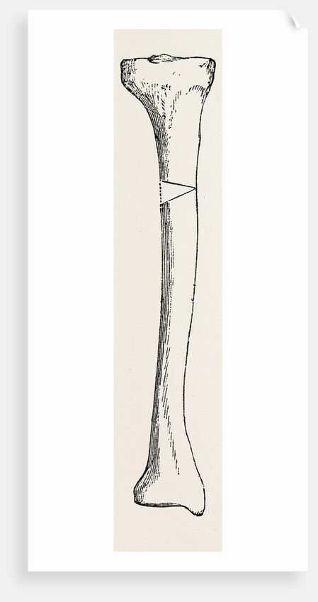 Diagram representing a curved tibia, with a wedge removed by Anonymous