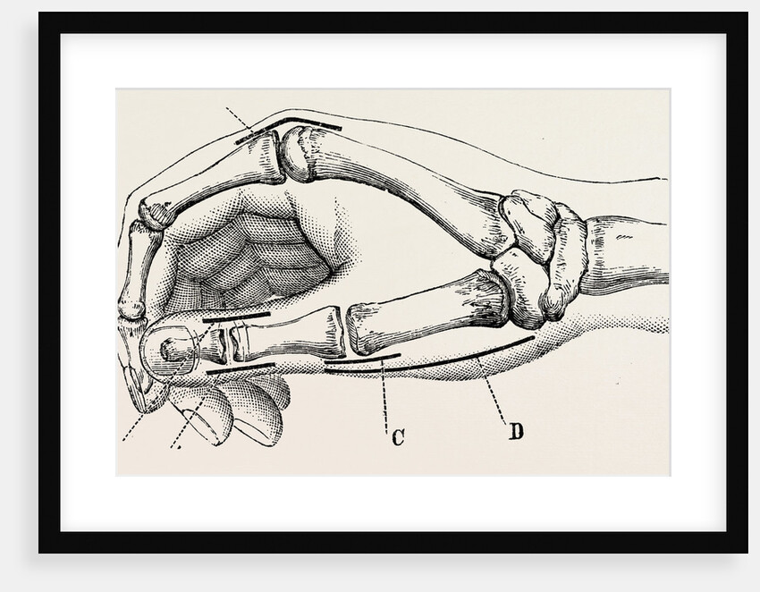 Excision of metacarpo-phalangeal joint by Anonymous