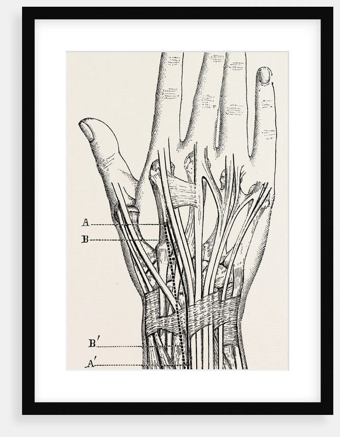 Excision of the wrist by Anonymous