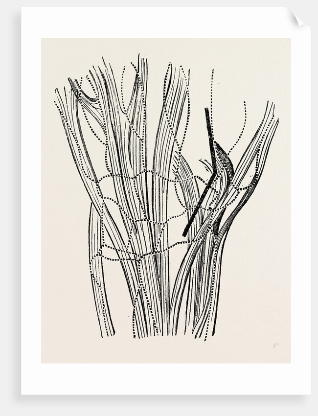 Excision of the wrist by Anonymous