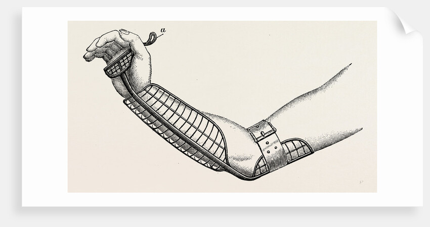 Ollieris wire splint for excision of the wrist by Anonymous