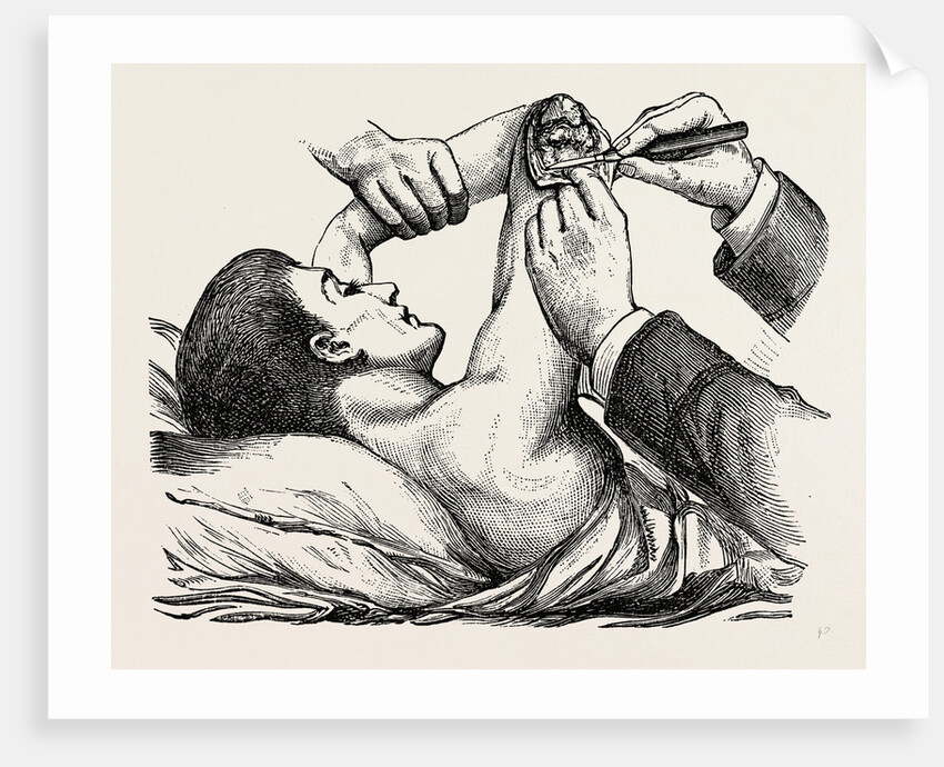 Excision of the elbow, the clearing of the humerus by Anonymous