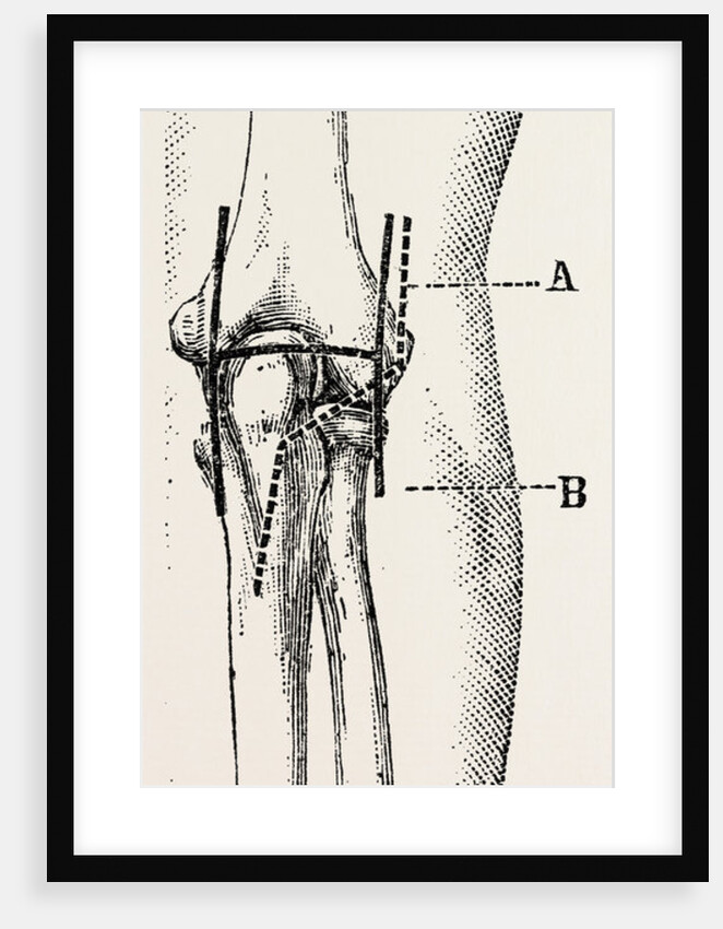 Excision by Anonymous