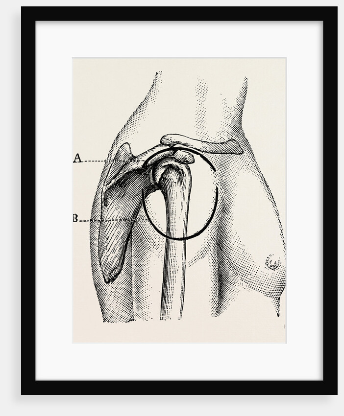 Excision of the shoulder by Anonymous