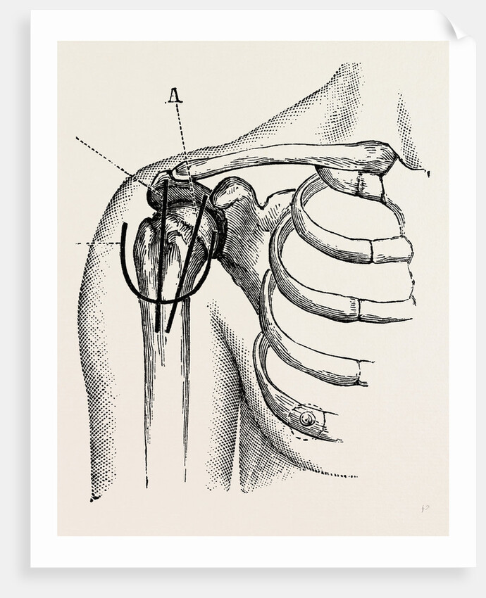 Excision of the shoulder by Anonymous