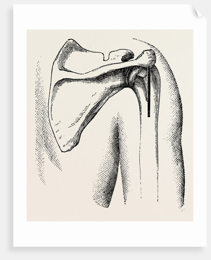 Excision of shoulder by Anonymous