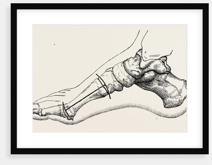 Excision of first metatarsal bone by Anonymous