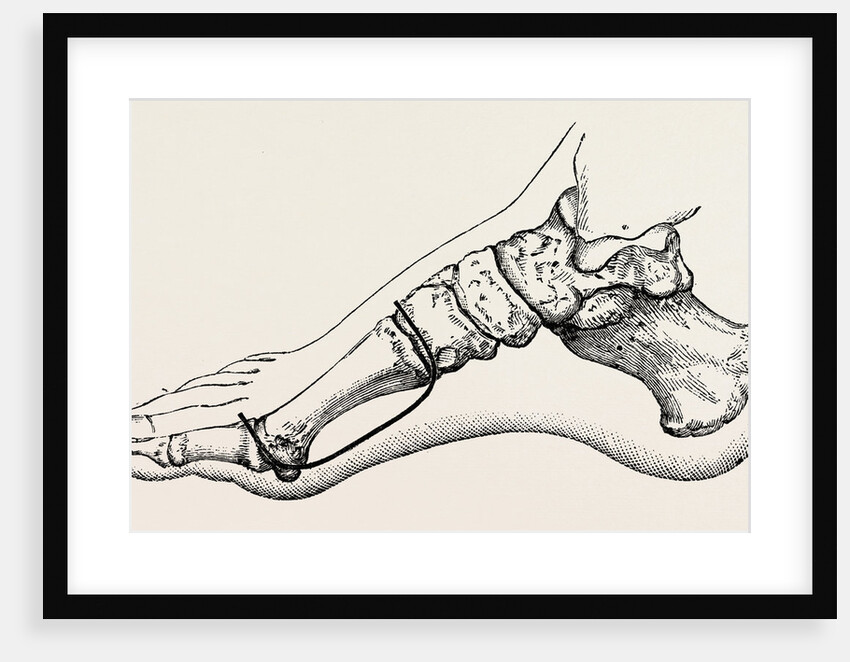 Eicision of first metatarsal bone, flap by Anonymous