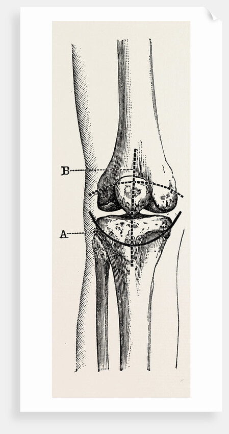 Excision of the operation the limb by Anonymous