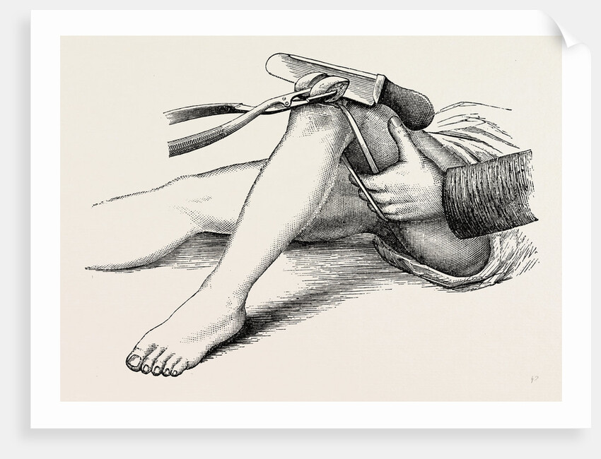 Excision of the knee, the sawing of the lower end by Anonymous